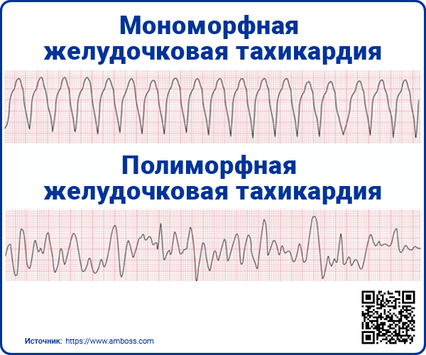 Мономорфная желудочковая тахикардия